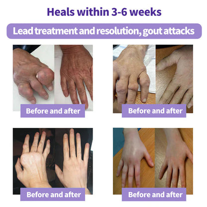 ⏰Last Day Promotion: BUY 1 GET 1 FREE🔥Lovilds™ Turmeric & Emu Oil Arthritis Soothing Pain Relief Massage Gel 👨‍⚕️Australian Osteopathic Association （AOA）Approved